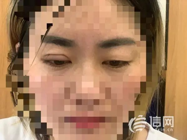 “打板”学员双眼皮效果 (来源:信网)
